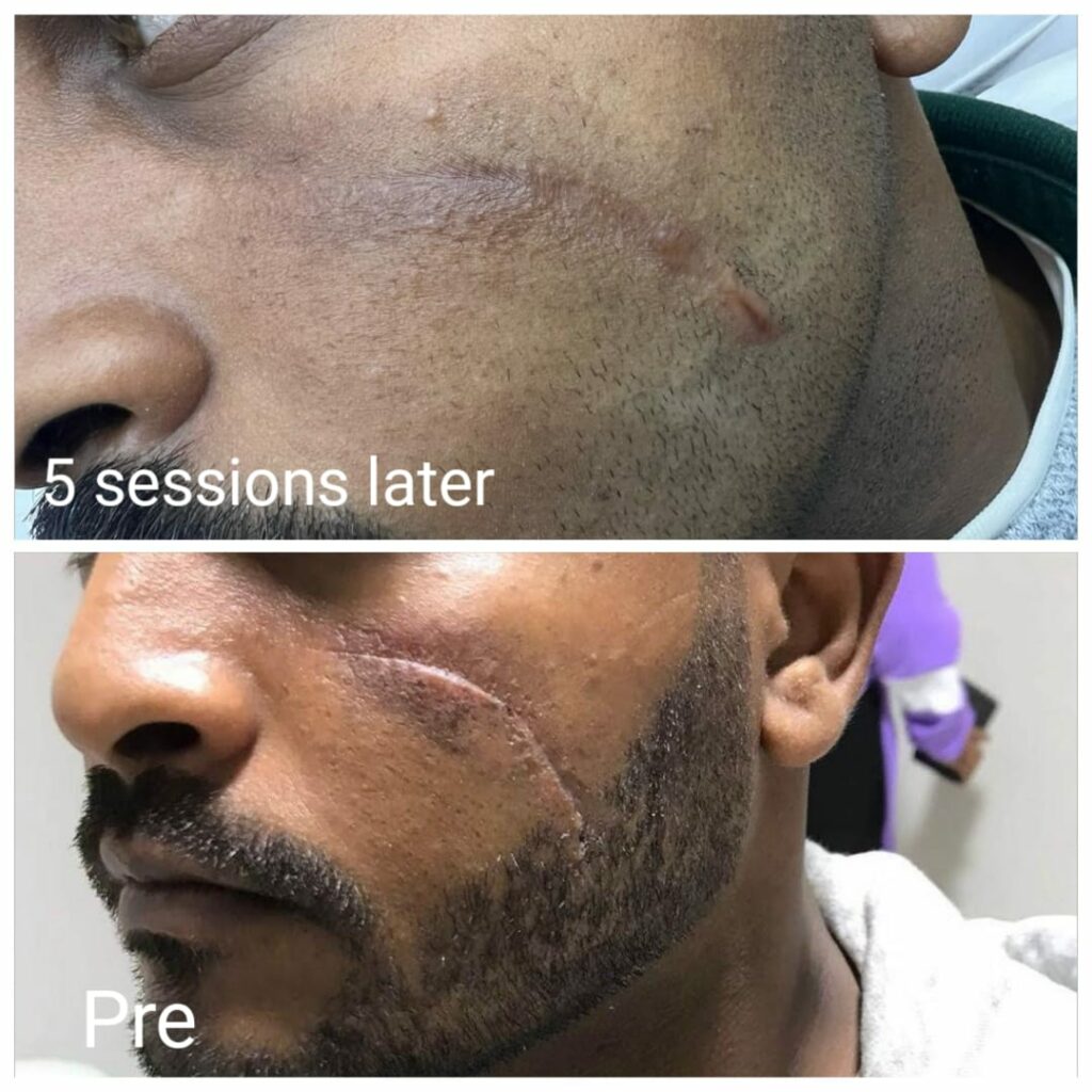 افضل اطباء ازالة ندب الوجه